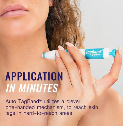 TagBand skin tag removal